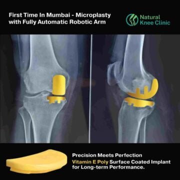 Image-16 Medical Breakthrough: Preserve Your Natural Knee with Absolute Precision Robotic Microplasty Surgical Technique