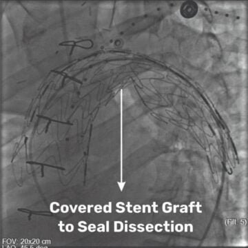 SSB-Heart-PNN-Featured Medical Marvel at SSB Heart and Multispeciality Hospital: Pioneering Hybrid Procedure Saves a Life
