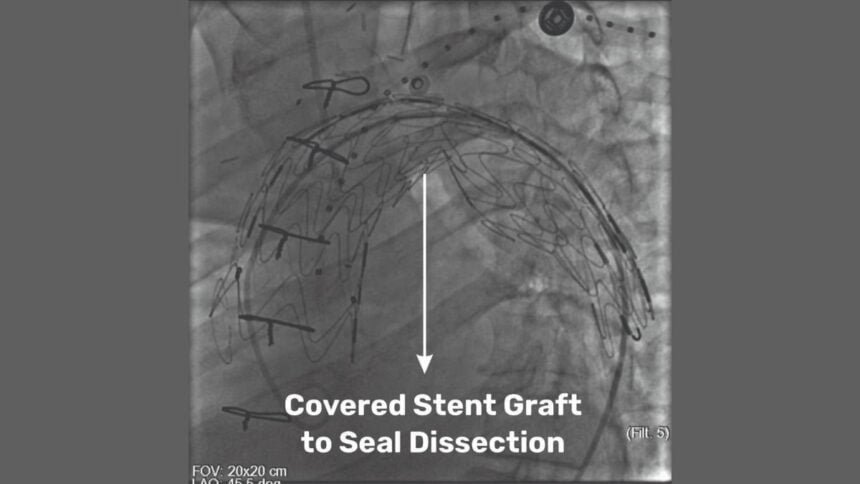 SSB-Heart-PNN-Featured Medical Marvel at SSB Heart and Multispeciality Hospital: Pioneering Hybrid Procedure Saves a Life