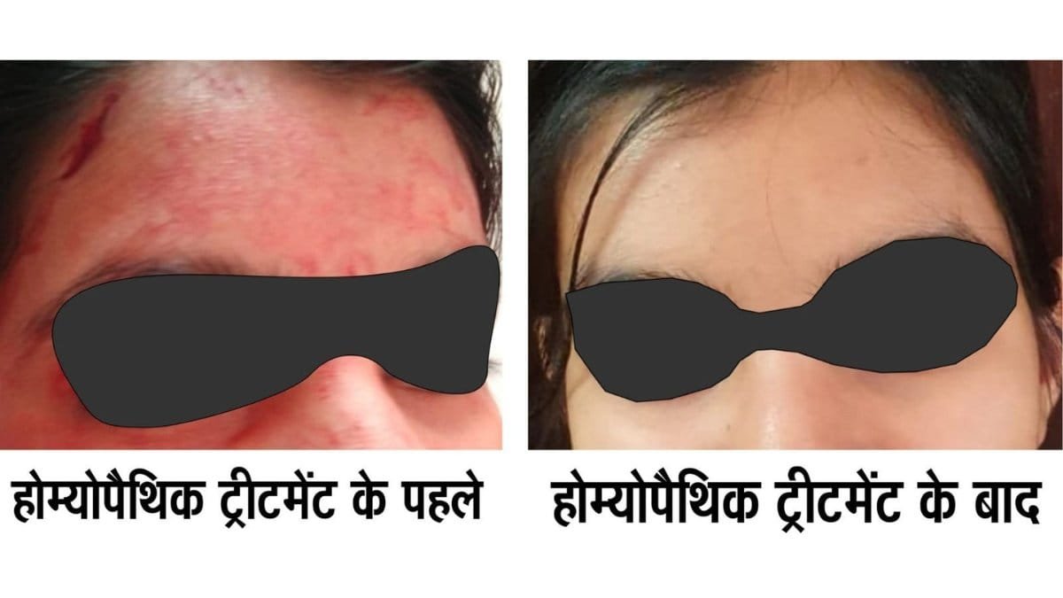 image-040623 Rare disease Blood-Sweating Disorder Successfully Treated with Advanced Homeopathy – Dr AK dwivedi