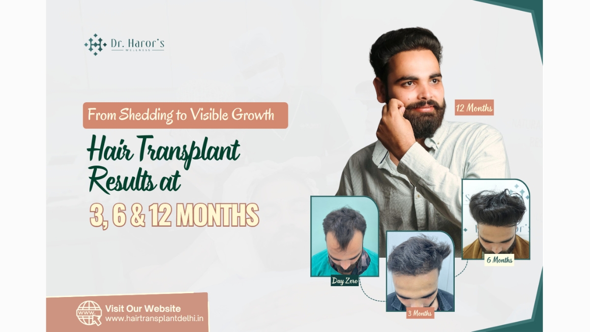 PNN-6-1 From Shedding to Visible Growth: Hair Transplant Results at 3, 6 and 12 Months