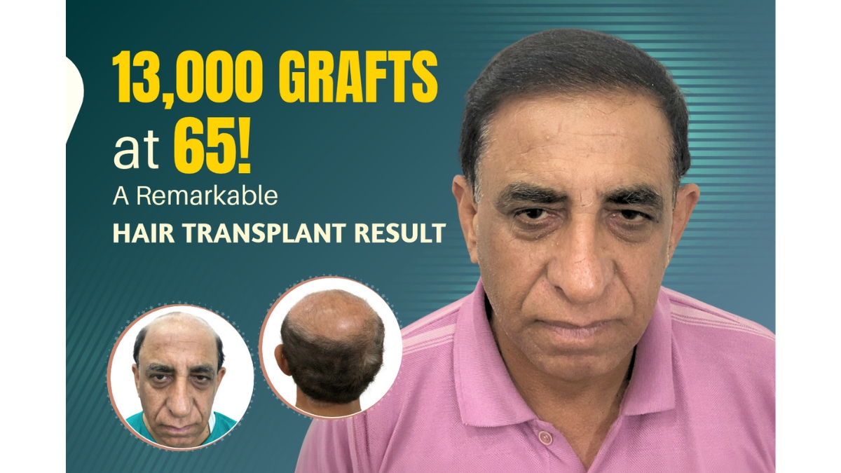 PNN-2026-10-07T163404.196 65-Year-Old, 13,000 Grafts Implanted in a Single Session: An Insight into a Remarkable Hair Transplant Procedure